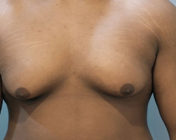 Gynecomastia Surgery